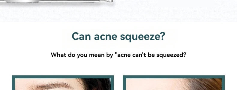 4Pcs/Set AcneTool Set