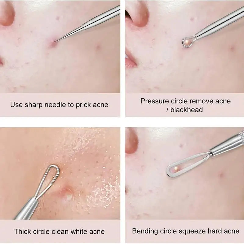 4Pcs/Set AcneTool Set